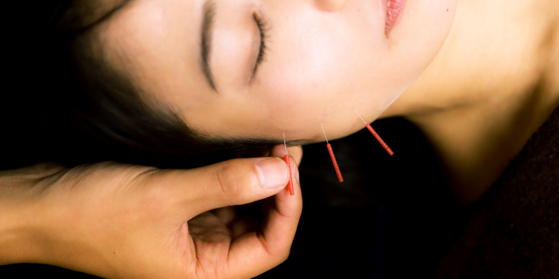 acupuntura-para-dolor-de-cabeza