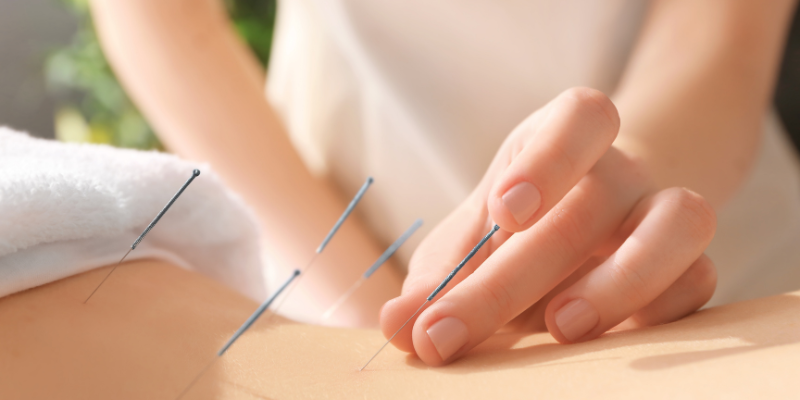 sesion-de-acupuntura-para-la-ansiedad