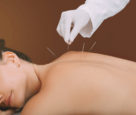 Acupuntura